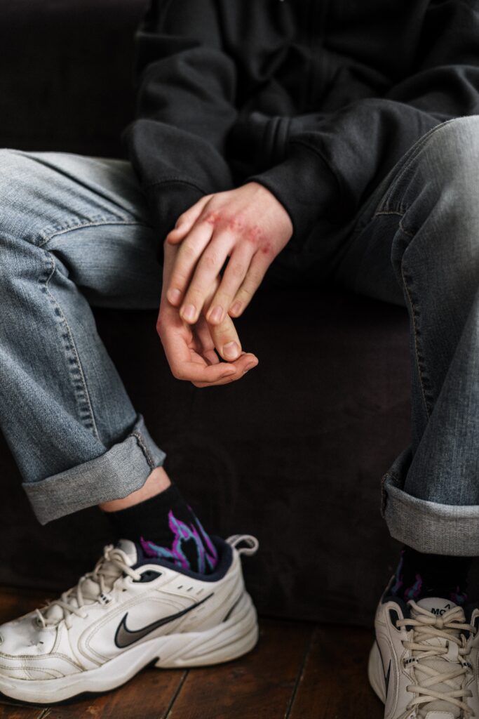 Image of teen with bruised knuckles, light skin, wearing black sweatshirt, jeans, purple flame socks, sneakers.