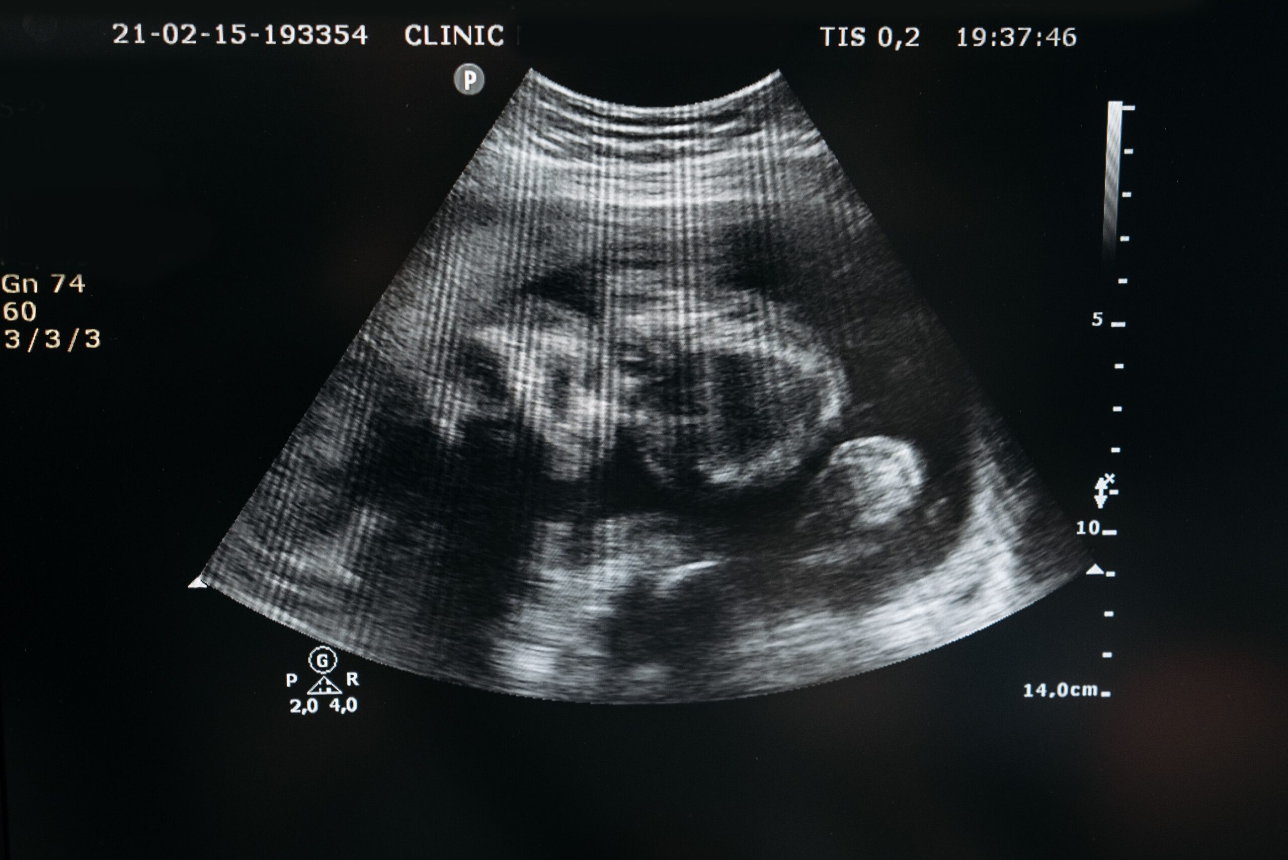 Personhood, When Convenient?